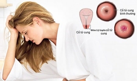 Viêm lộ tuyến có tự khỏi được không?