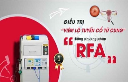 Review chữa viêm lộ tuyến bằng sóng cao tần RFA 