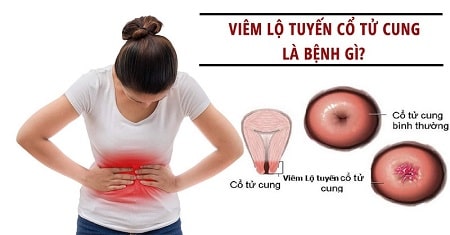 Viêm lộ tuyến là bệnh gì ?