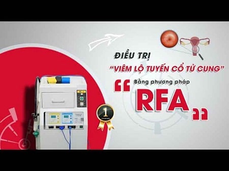 Cách điều trị viêm lộ tuyến ven lỗ cổ tử cung hiệu quả