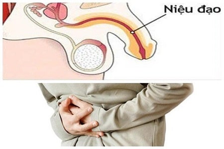 Vì sao chữa viêm niệu đạo mãi không khỏi 