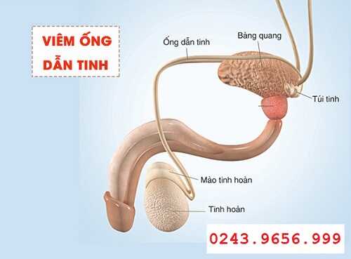 Viêm ống dẫn tinh