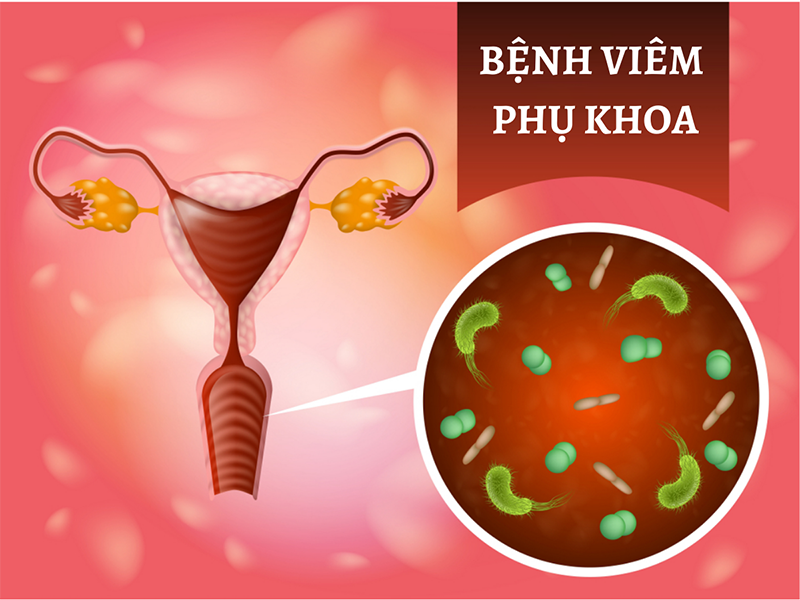viem-phu-khoa-uong-thuoc-gi-1
