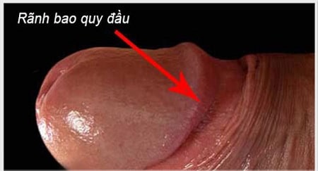 4 nguyên nhân viêm nhiễm rãnh bao quy đầu