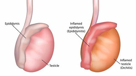 Dấu hiệu nhận biết viêm tinh hoàn tái phát