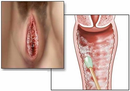 Nguy hiểm do nhiễm nấm Candida vùng kín nữ giới cần biết