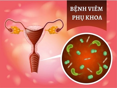 Hiểu đúng về viêm phụ khoa ở nữ giới