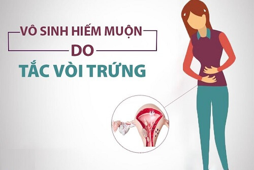 Vô sinh hiếm muộn do vòi trứng bị tắc