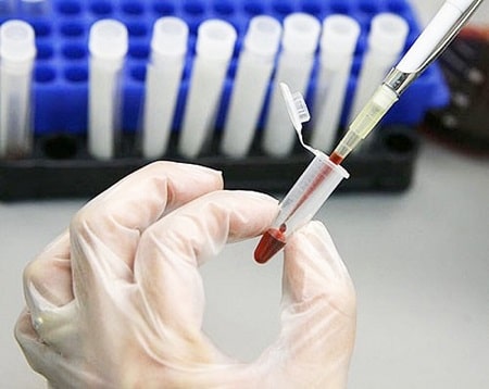Các phương pháp xét nghiệm giang mai hiện nay