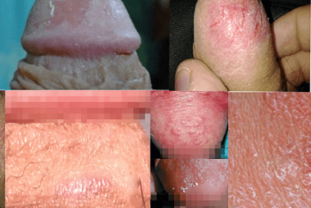 Nguyên nhân gây viêm bao quy đầu ở nam giới ?